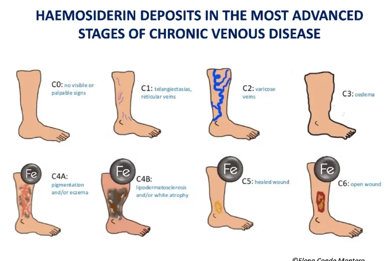 Ankle Ochre Dermatitis