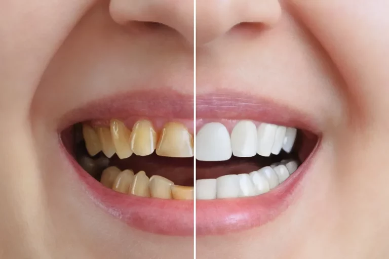 white teeth whitening