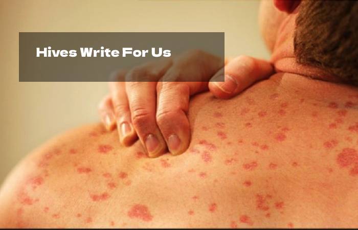 Hives Write For Us 