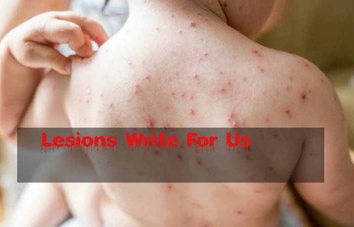 Lesions Write For Us
