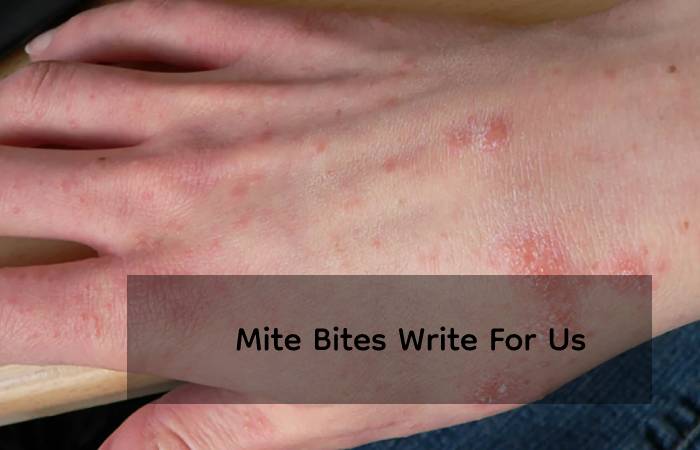Mite Bites Write For Us 
