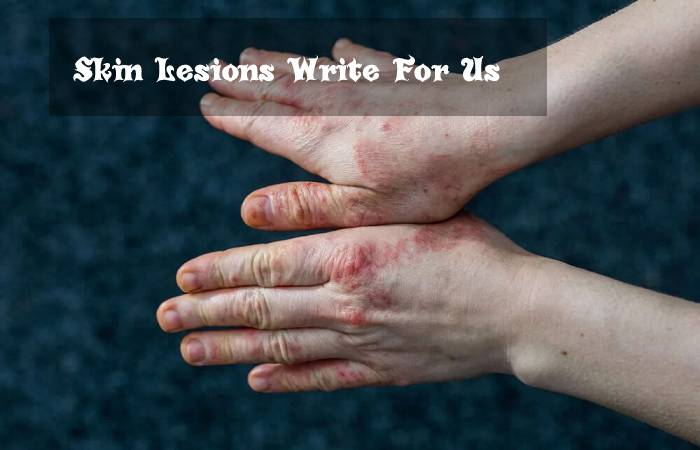 Skin Lesions Write For Us