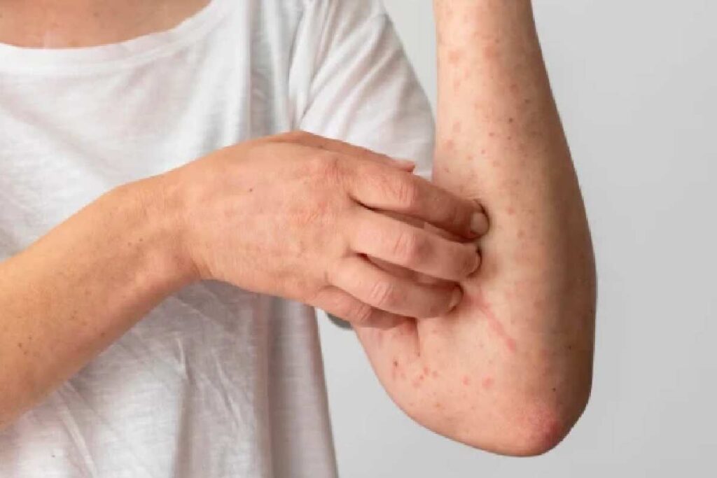 What are Scabies prevention?