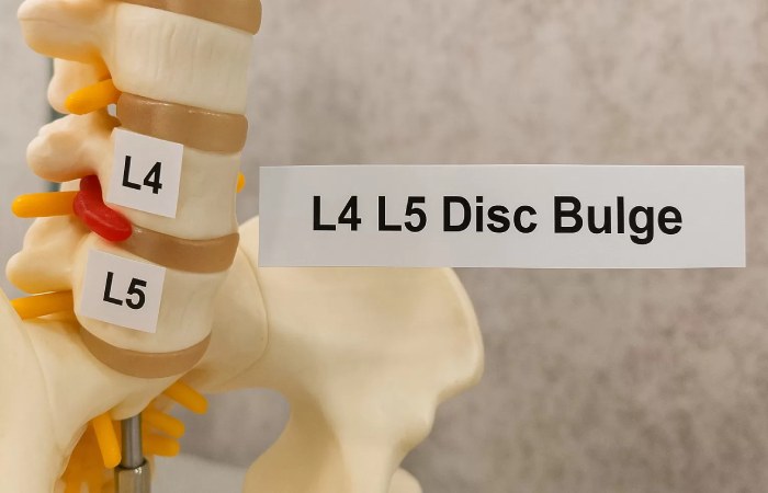 L4-L5 Disc Bulge Treatment