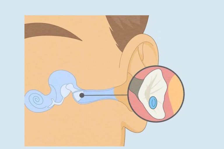 How to Drain Fluid from Middle Ear at Home